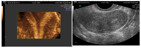  2D and 3D image showing septate uterus
