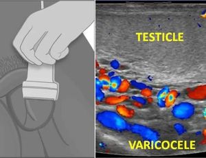 Vericocele and scrotal doppler