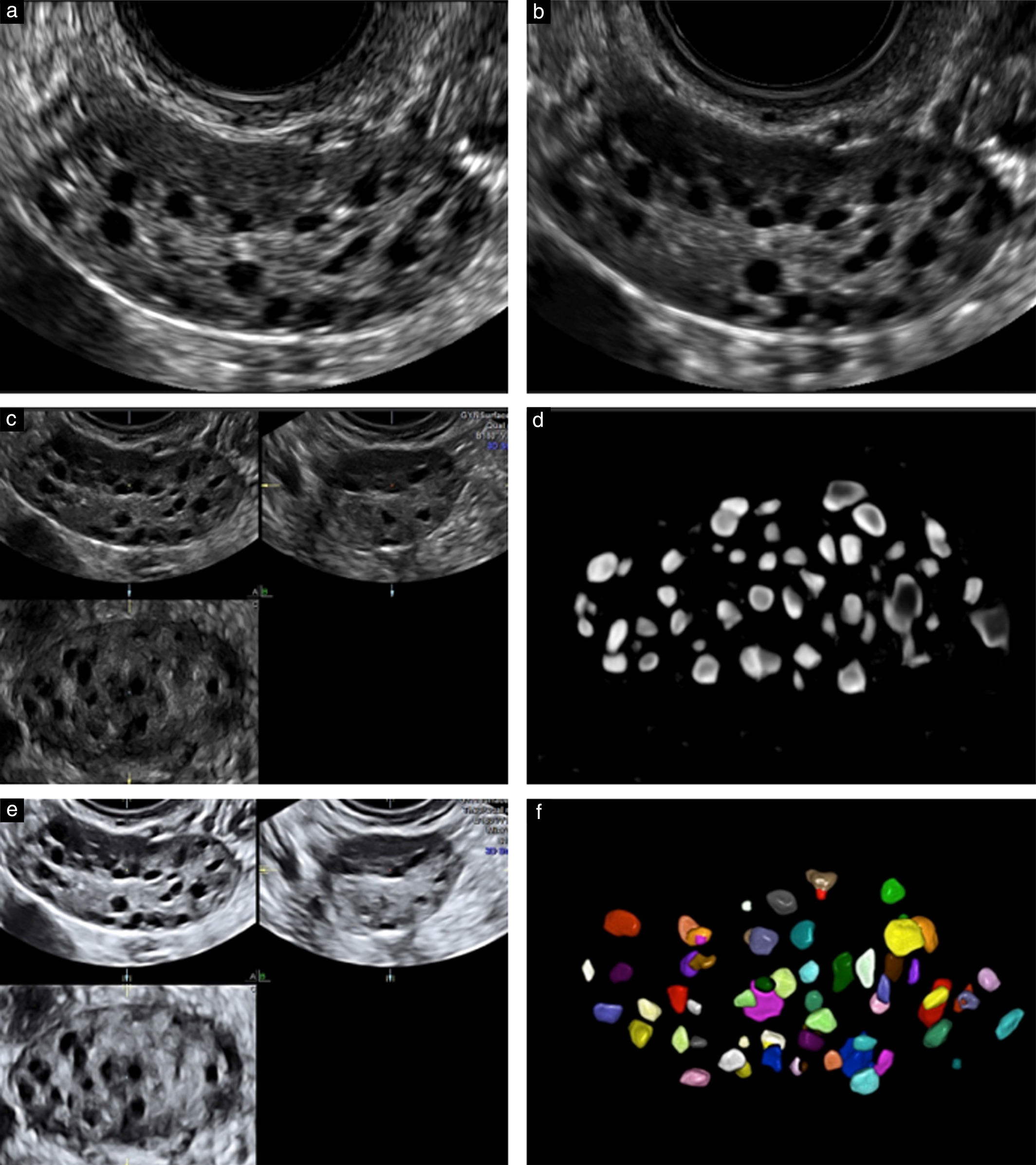 Antral follicle count on 2D imaging and sono AVC (3D)