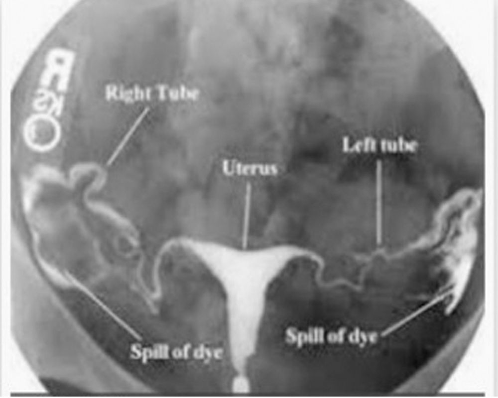 Tubal Patency Test Sunflower Hospital