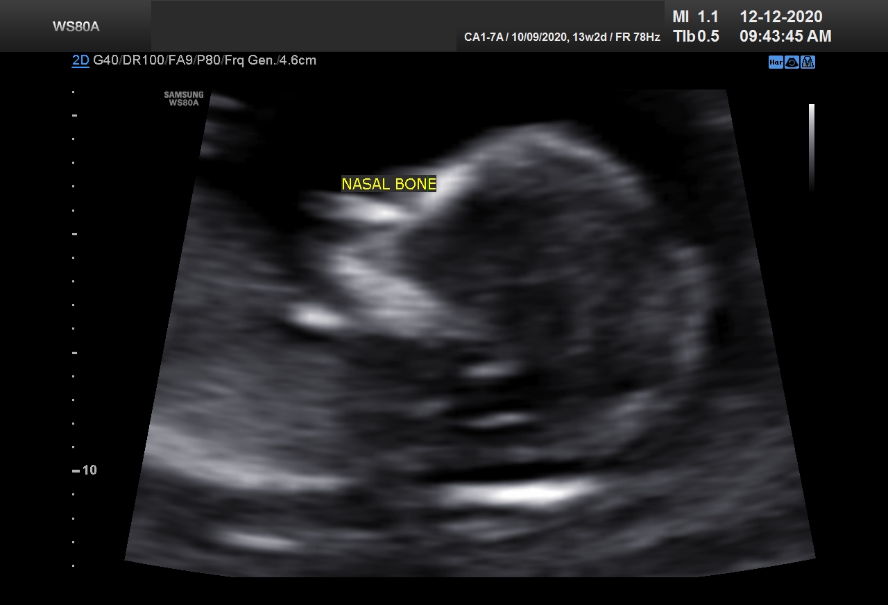 Sonography Image