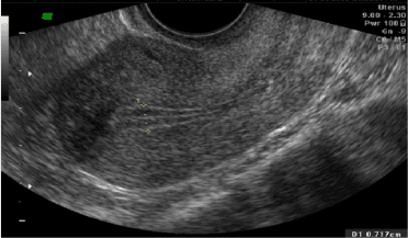 Transvaginal ultrasound showing a mid-cycle triple-line endometrial pattern.