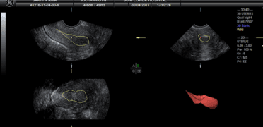 3D/4D assessment of uterine cavity volume, interpreted alongside other findings.