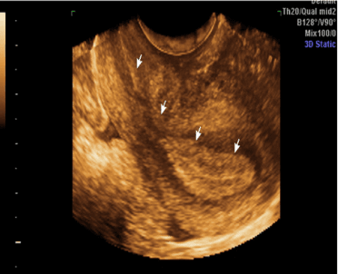 3D image of a thickened endometrium in the secretory phase.