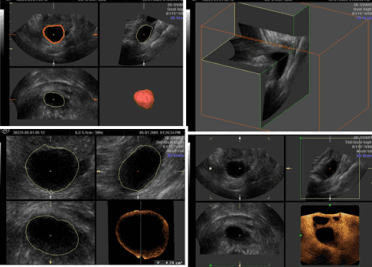 3D/4D measurement of follicular volume before ovulation.