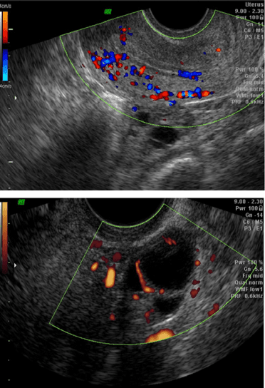 Colour Doppler showing myometrial and endometrial vascularity near ovulation.