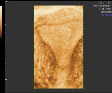 Power Doppler showing blood flow around a follicle.
