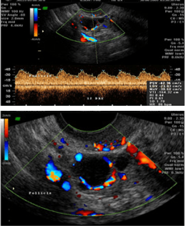 3D view of a thickened endometrium.