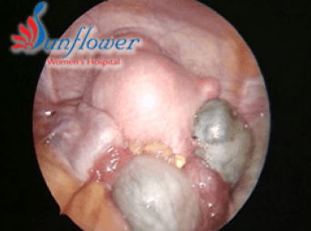 Endometriosis