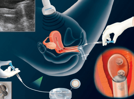 embryo transfer