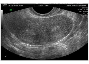 Septate uterus