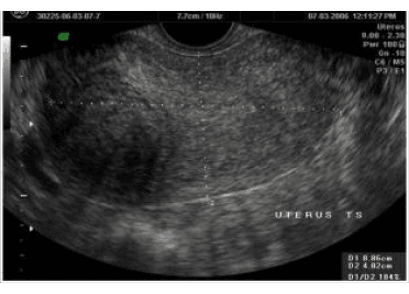 USG image of Polycystic Ovary