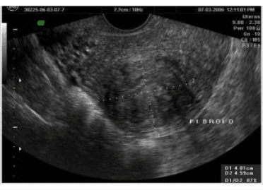 USG image of fibroid (Fibromyoma)