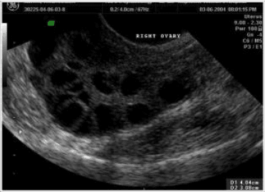 Doppler study of follicle