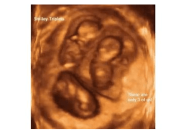 USG image of 3D triplet babies