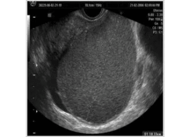 USG image of Endometrioma