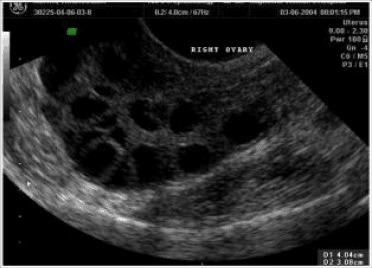 USG image of Polycystic Ovaries
