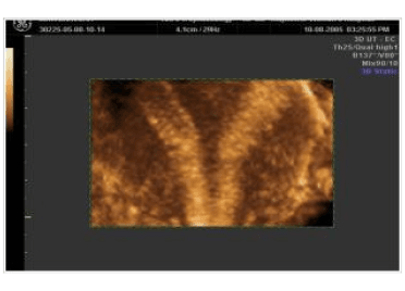 Septate uterus