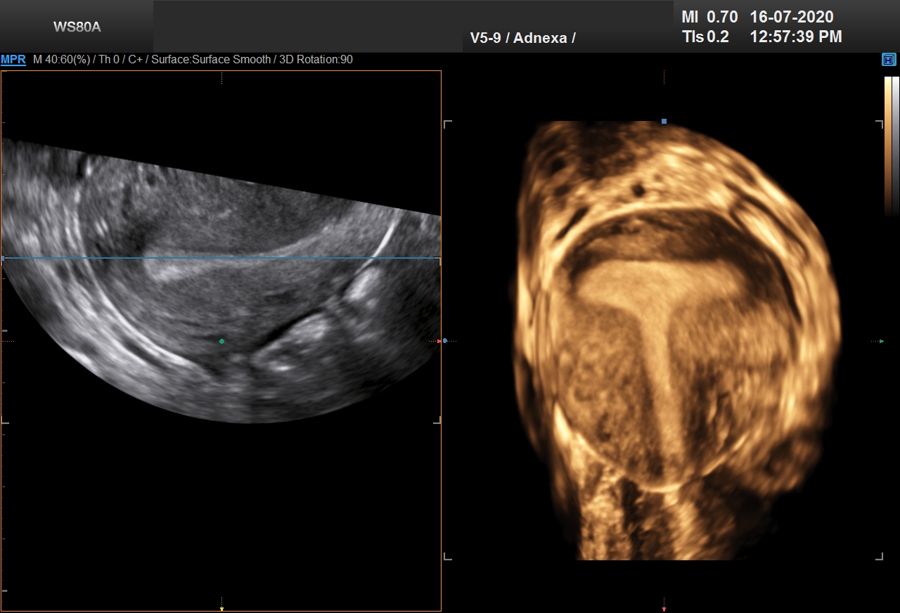 T CAVITY SHAPE_0008