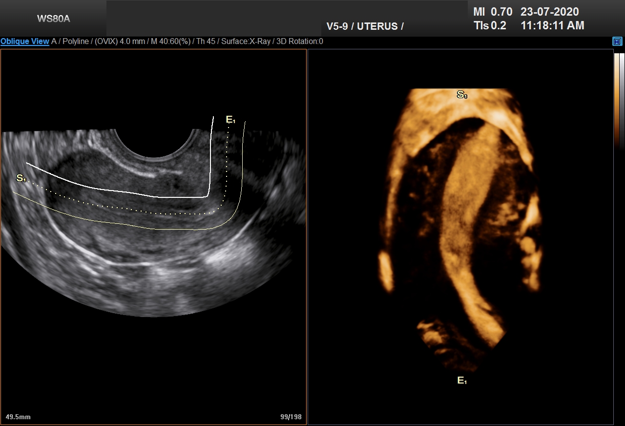 UNICORNUATE UTERUS_0001