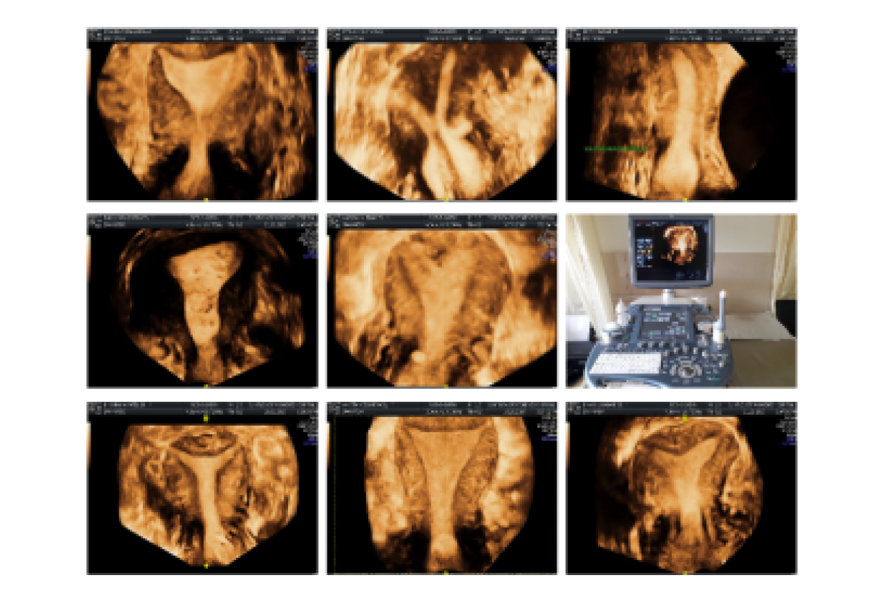 Different uterine cavity
