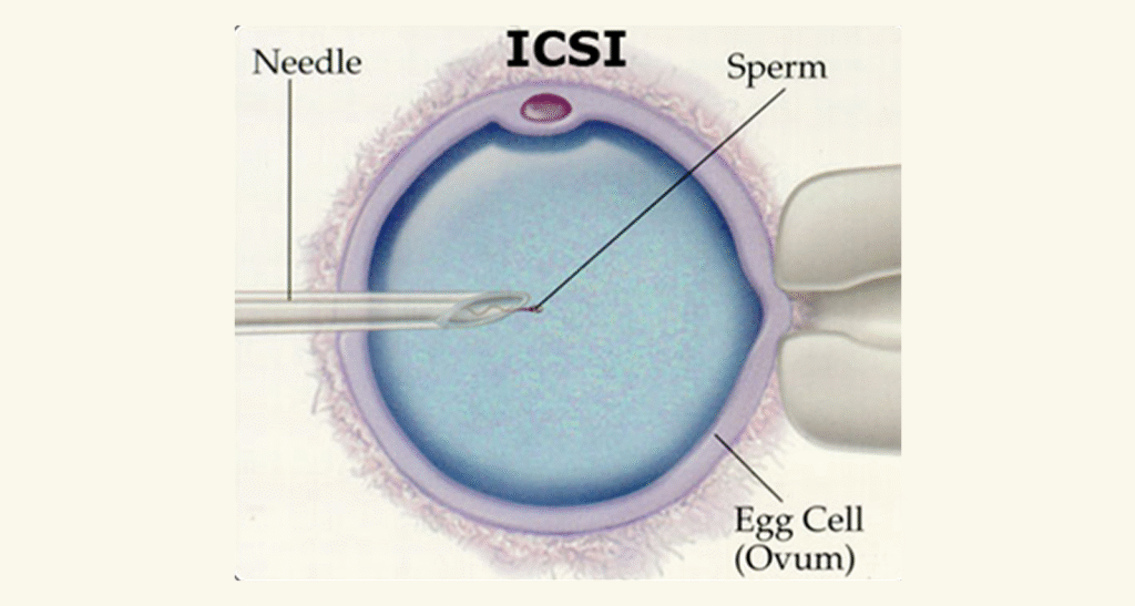 ICSI services
