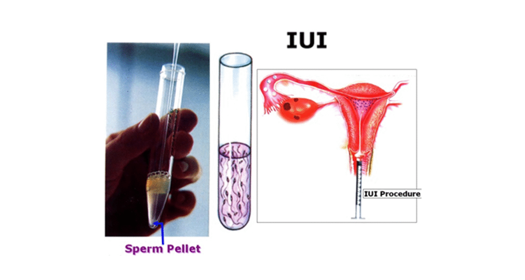IUI services