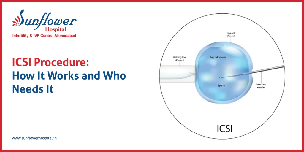 ICSI