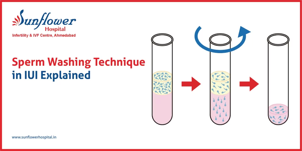 Sperm Washing Technique