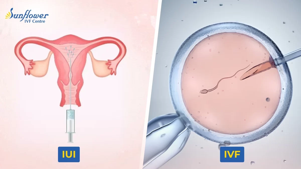 IUI vs IVF Treatment: Differences in Process, Cost and Treatment Time