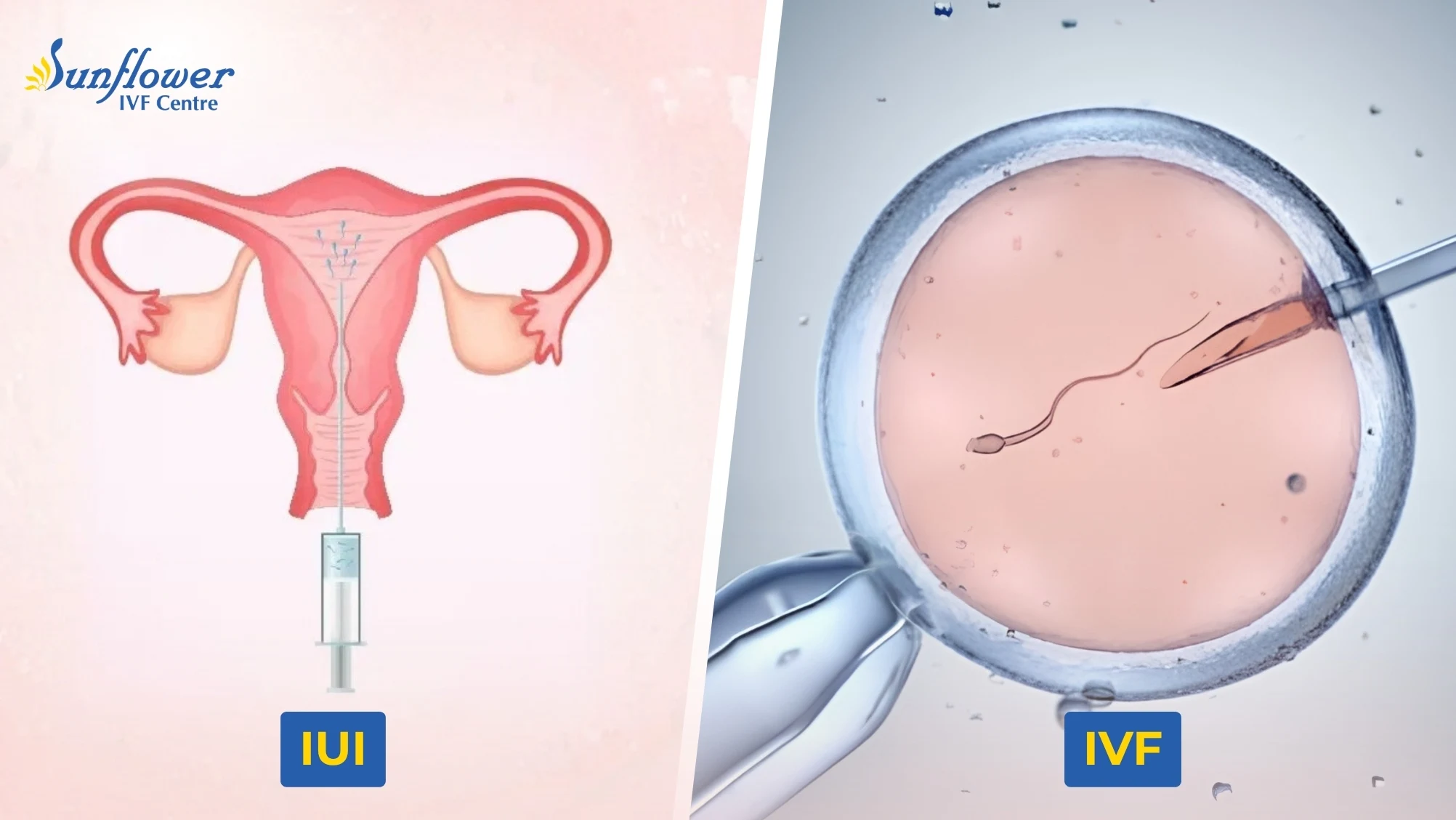 IUI vs IVF Treatment: Differences in Process, Cost and Treatment Time
